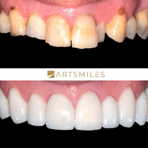 Before and after of pearly white porcelain veneers