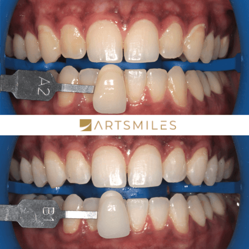 Before and after of teeth whitening B1