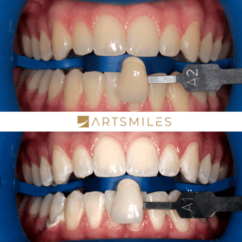 Before and after of teeth whitening