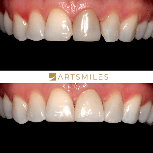 Before and after of stained tooth using porcelain veneers
