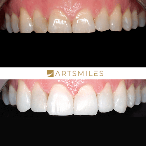 Before and after of full mouth composite veneers