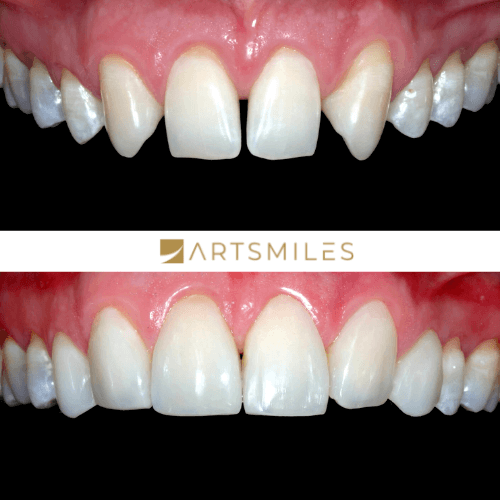 Before and after of misaligned teeth fixed with porcelain veneers