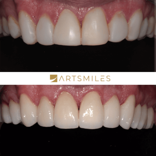 Before and after of porcelain veneers full mouth