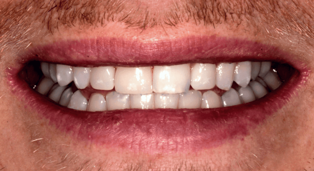 Smile of a man after porcelain veneers