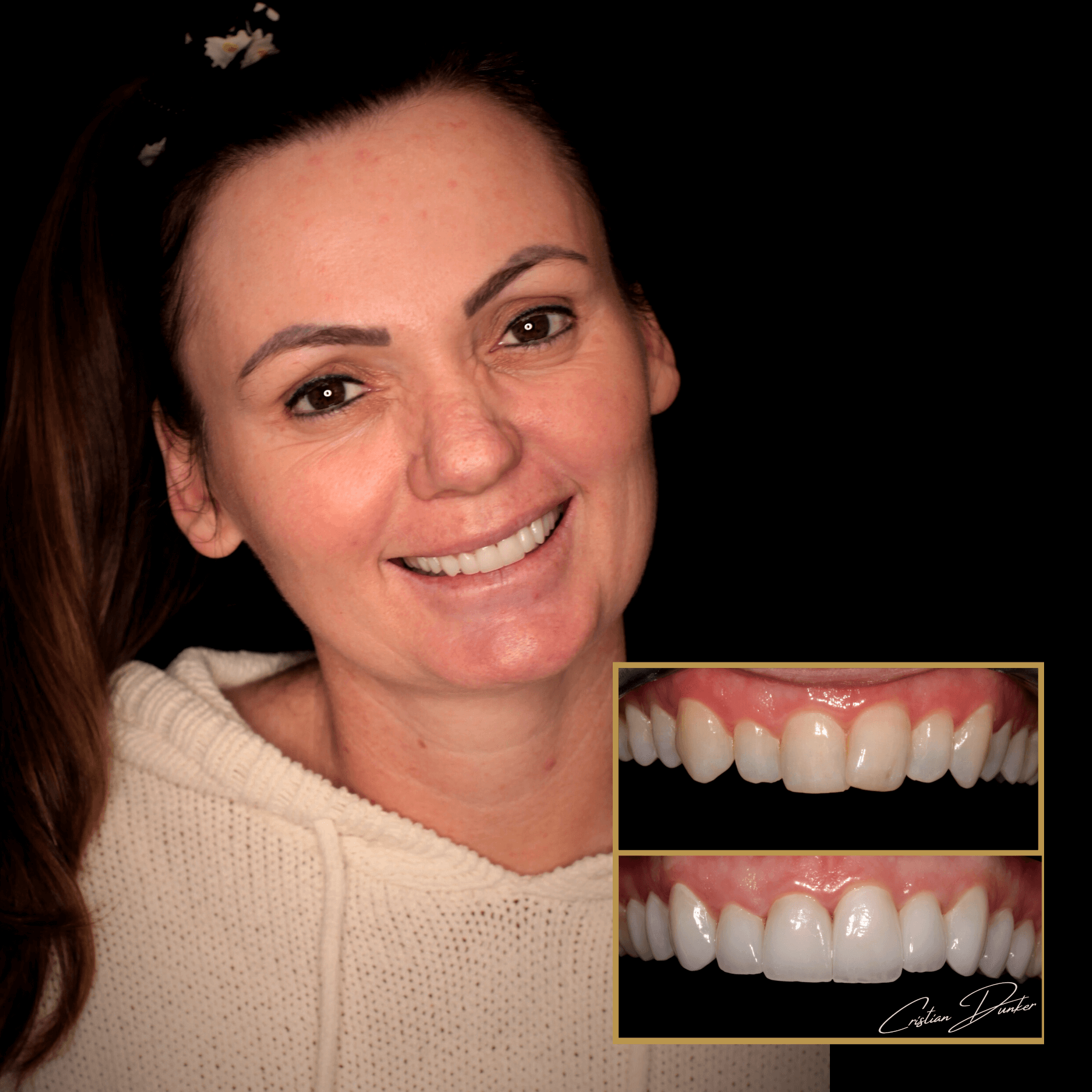 porcelain veneers cost