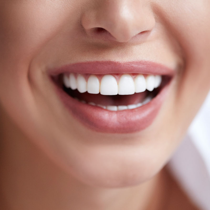 Artsmiles Dental Veneers