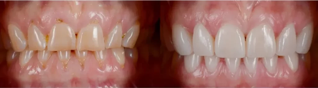 Dental-veneers-Before-and-after