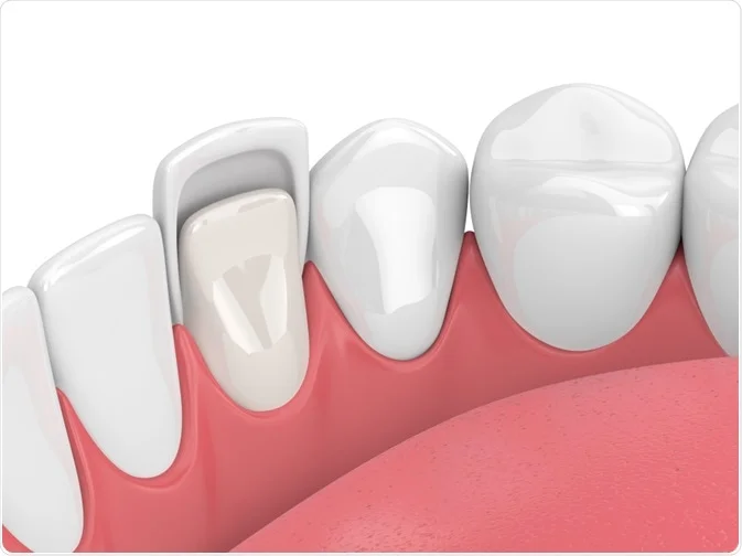 Veneer Application Process