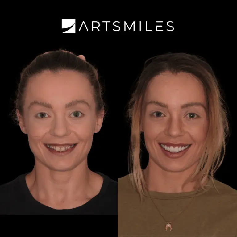 Before and after full mouth rehabilitation ceramic veneers Artsmiles