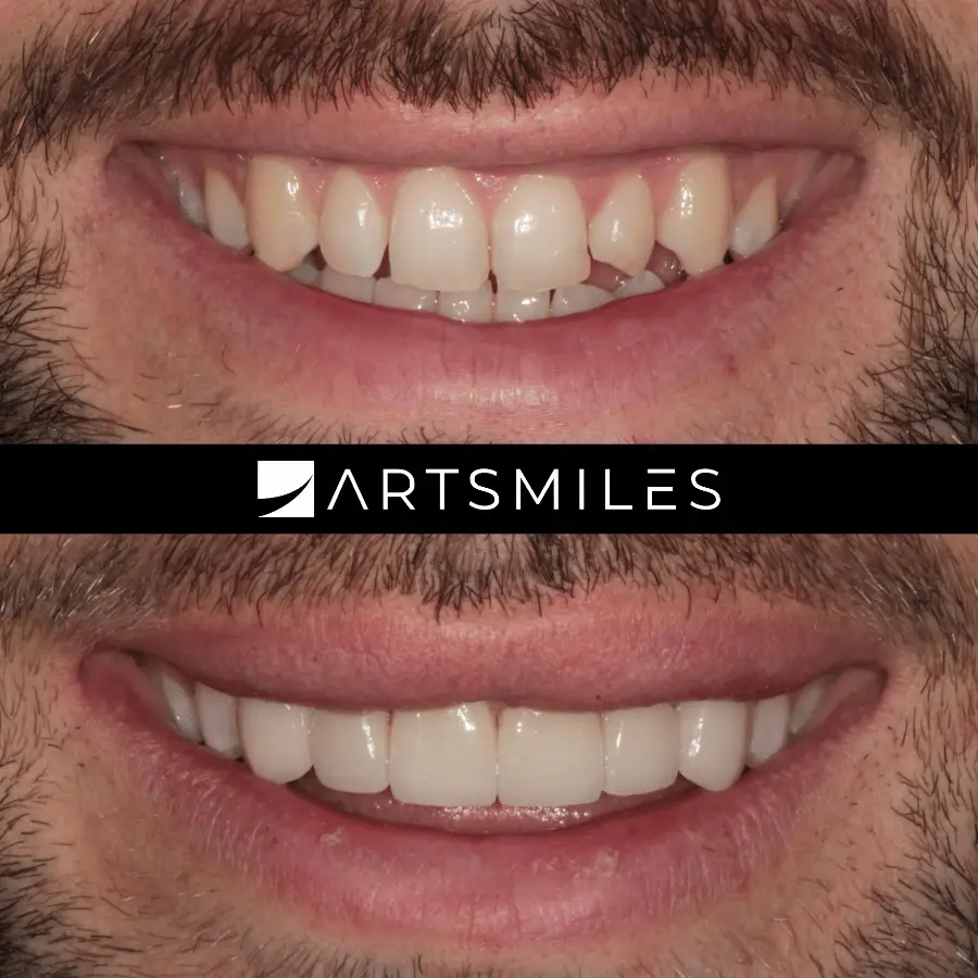 dental veneers artsmiles