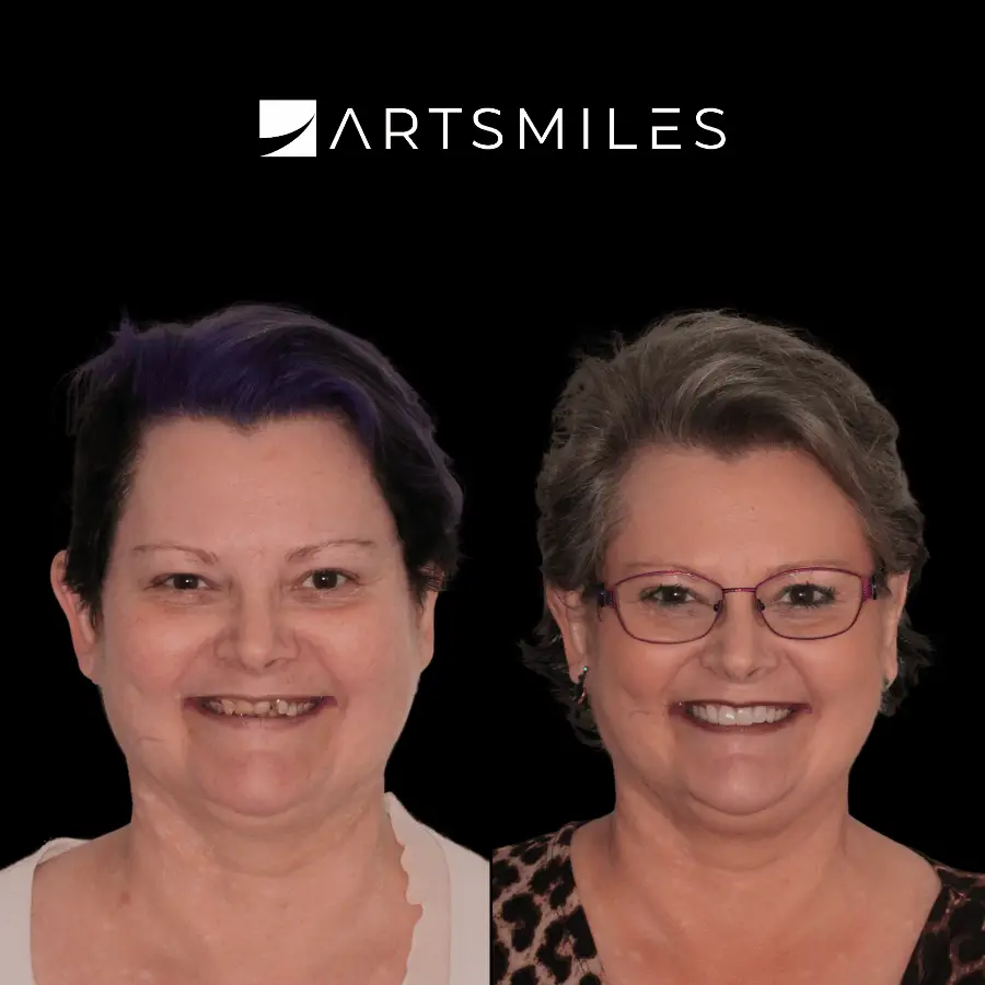 dental veneers artsmiles