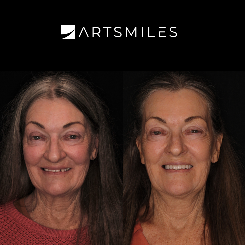 All-on-4 Artsmiles, non-metal bridge, All on x Gold Coast, Implant, Implant Gold Coast