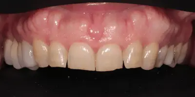 Upper arch rehabilitation with zirconia veneers and bone surgery