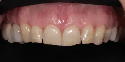 Upper arch rehabilitation with zirconia veneers and bone surgery