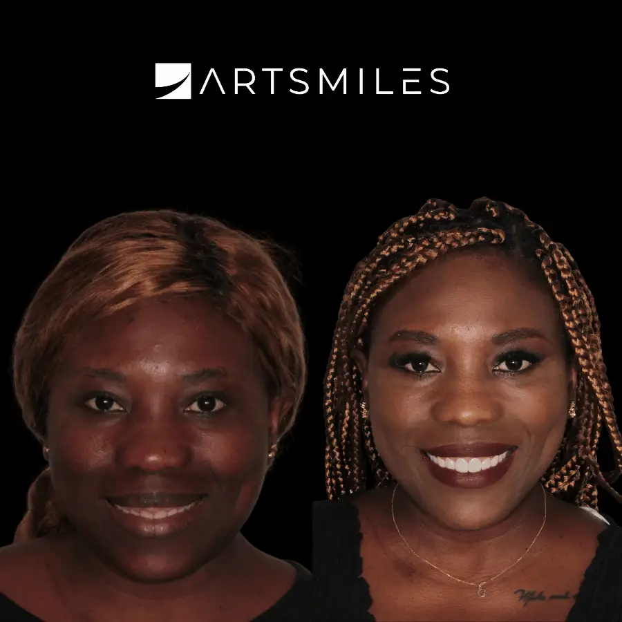 dental veneers artsmiles