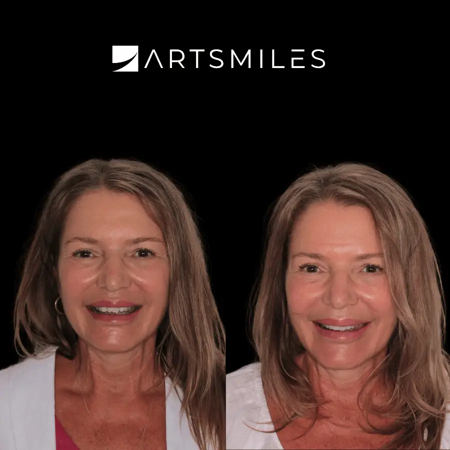 dental veneers artsmiles