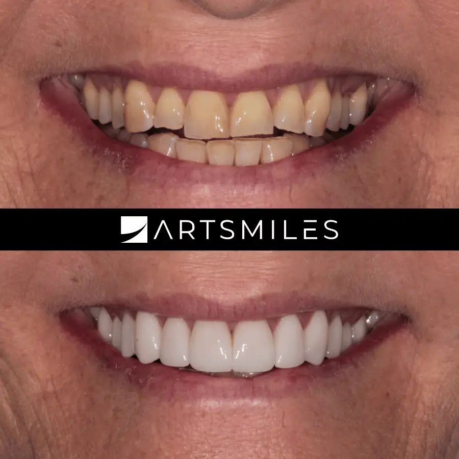 dental veneers artsmiles