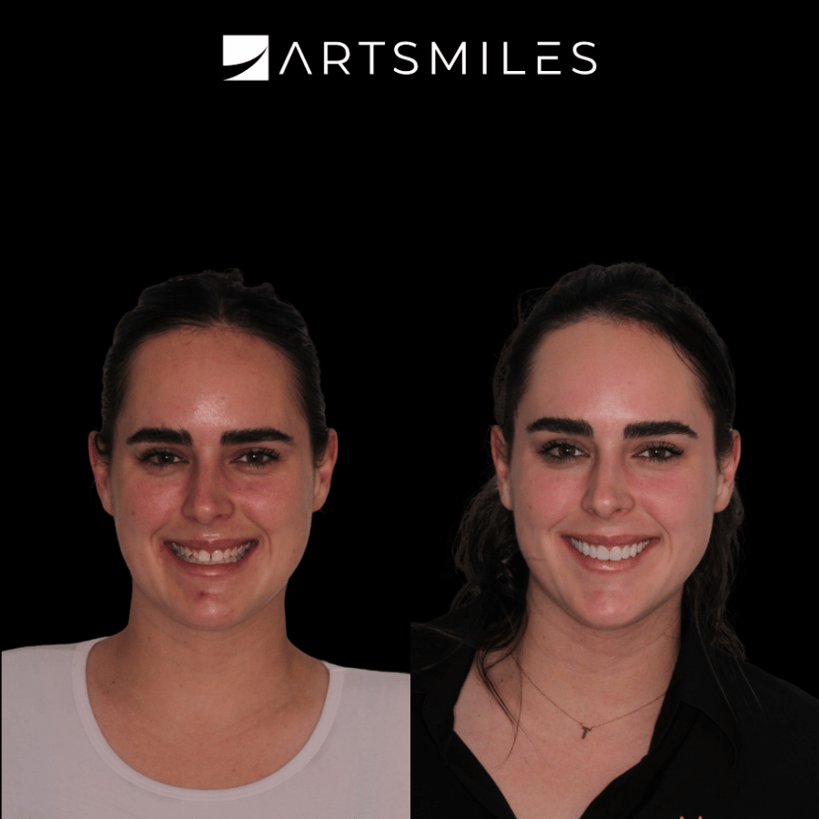 Dental veneers before and after – ArtSmiles Gold Coast