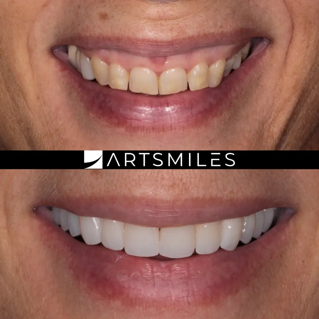 Before and after zirconia veneers dental veneers Gold Coast