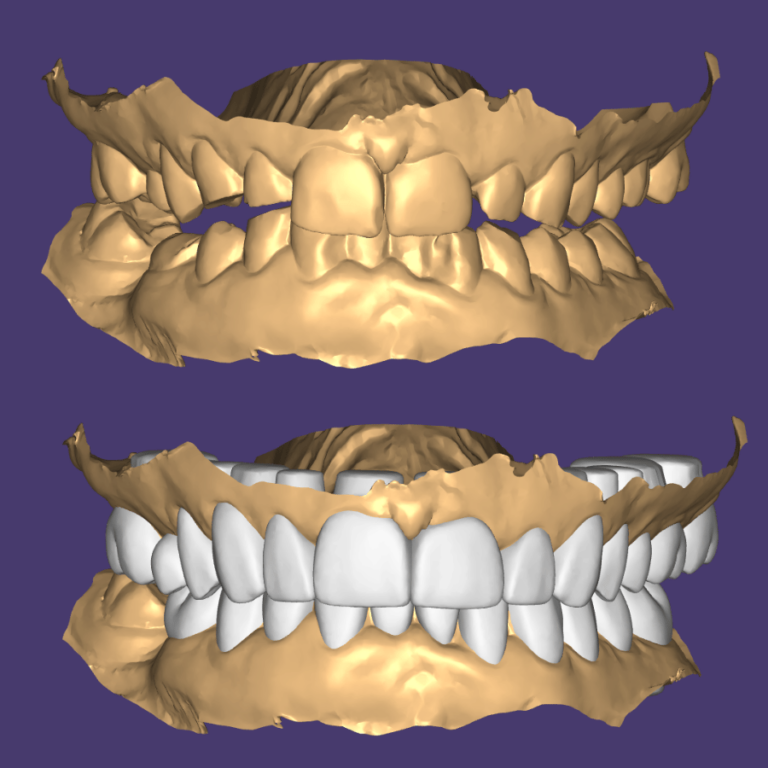 Smile design full mouth rehabilitation Artsmiles Dental veneers Gold Coast