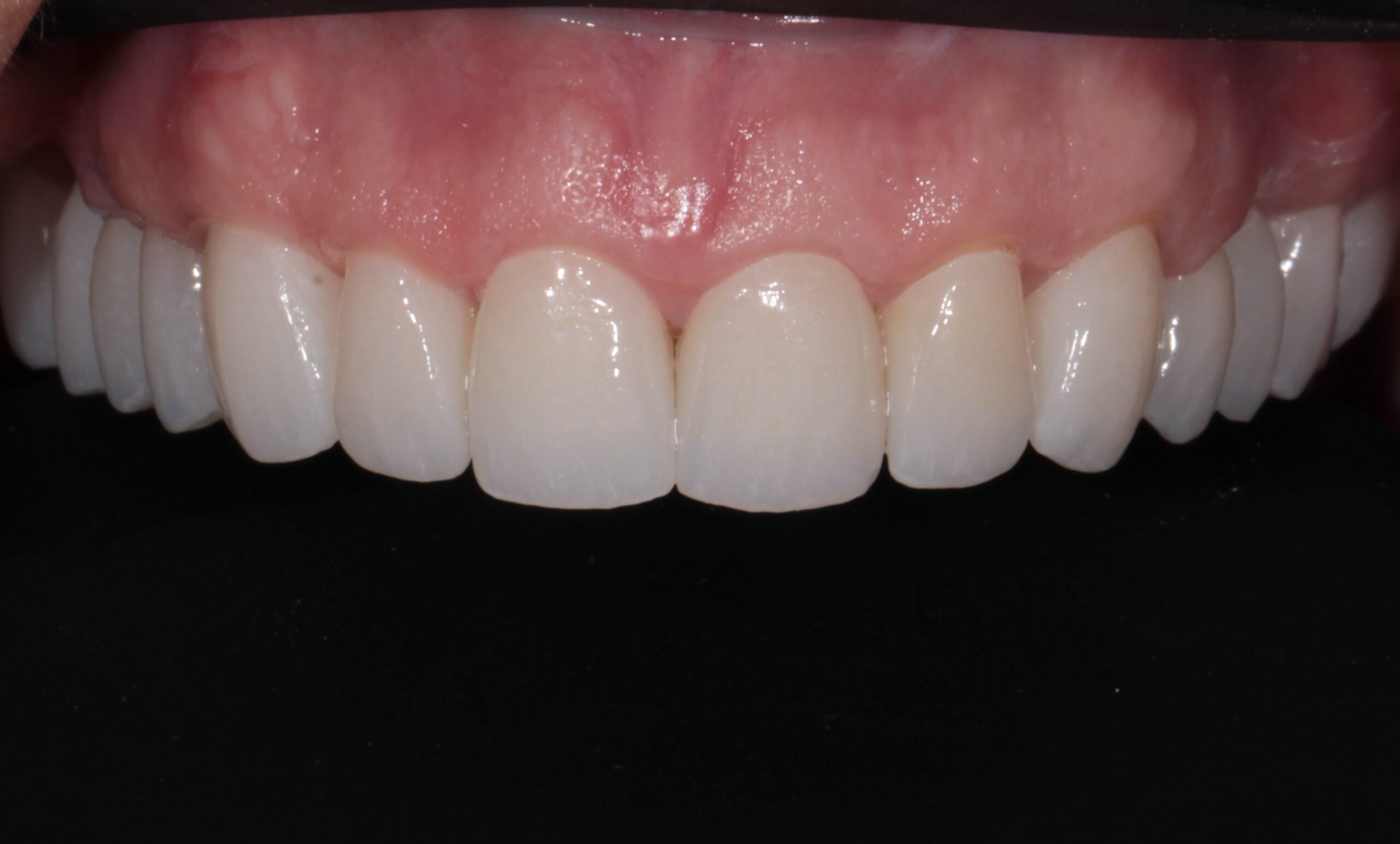 Upper arch rehabilitation with zirconia veneers and bone surgery