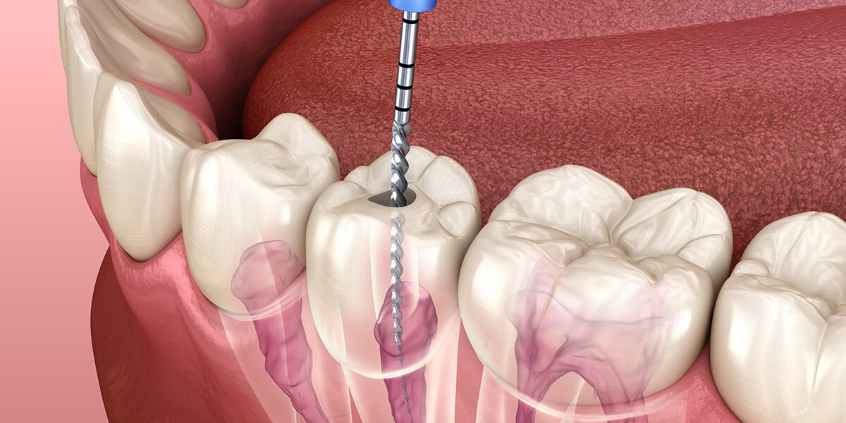 Important points about Dental Root Canal with a Crown 1 1200x600 1