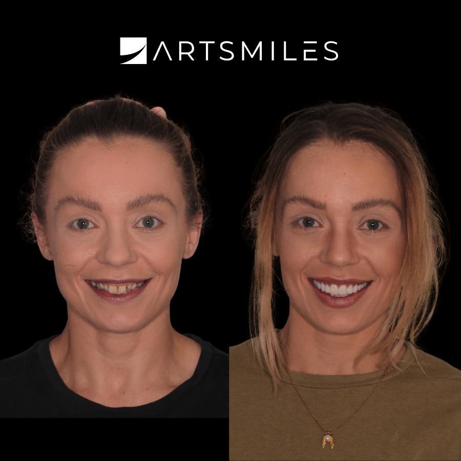 Time Taken After Procedure: Approx 2 week