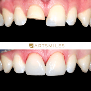 Before and after of broken tooth fixed with veneers