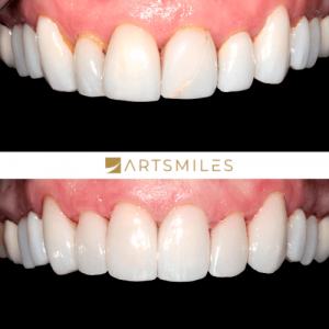 Before and after of full mouth rehabilitation