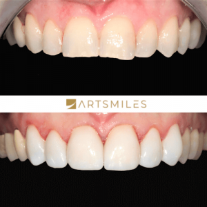 Before and after of 6 teeth porcelain veneers