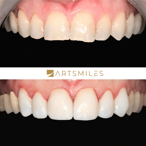 Before and after of 6 teeth porcelain veneers