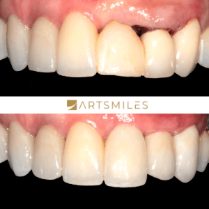 Before and after of porcelain veneers partial