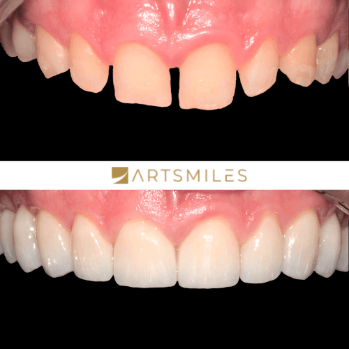 Before and after of porcelain veneers top teeth