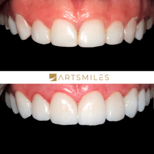 Before and after of veneers and gum lift