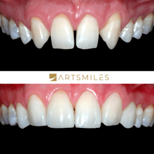Before and after of misaligned teeth fixed with porcelain veneers