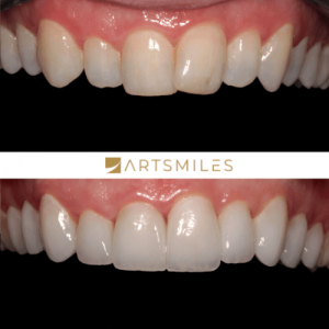 before and after dental veneers