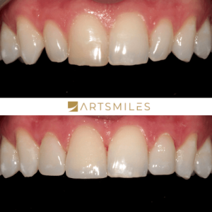 Before and after of porcelain veneers front teeth