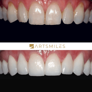Before and after of porcelain veneers
