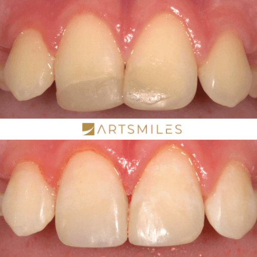 Before and after of a cosmetic filling