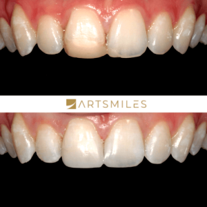 before and after of a composite veneer