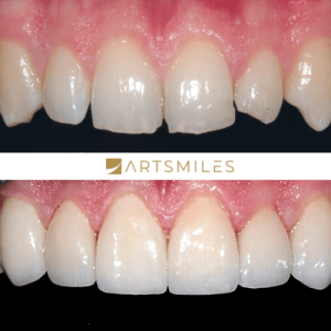 Before and after of Smile Makeover